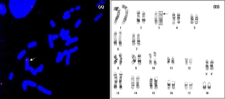 Fluorescence in situ hybridization (FISH) analysis using a rhodamine-labeled probe containing the human FasL gene and karyotyping demonstrated the integration of the cells obtained from membrane-bound FasL (F4-41, A) with normal karyotype (B).