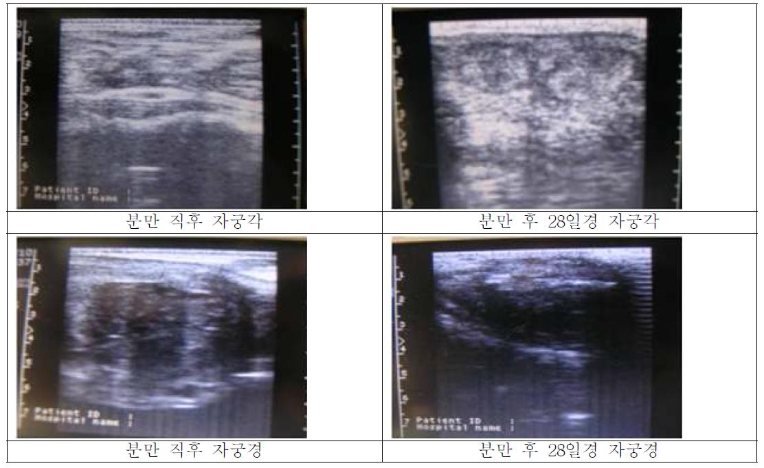 분만후 초음파기기를 통한 자궁회복도 변화양상