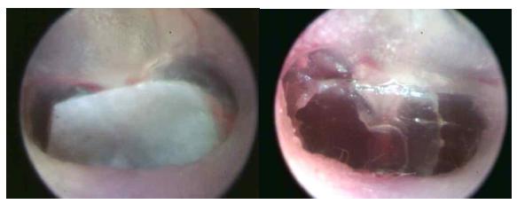 고막 천공 후 시행한 실크 패치(좌측)와 종이 패치(우측).