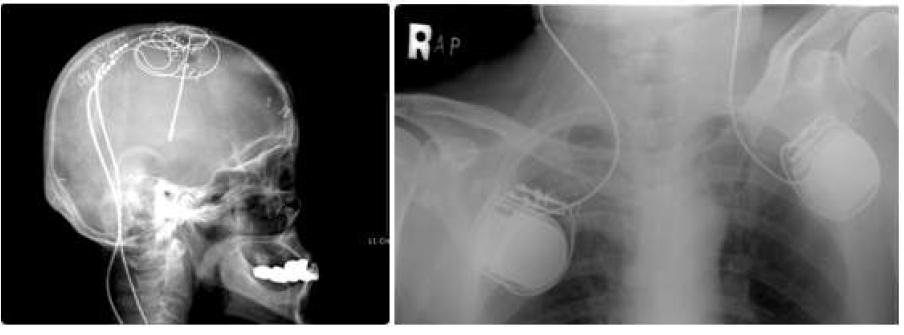 An electrode and batteries for DBS controlling the motor action of a PD patient.