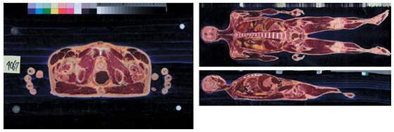 Visible Human Project의 신체절단면으로서 전후단면, 좌우단면 영상 사진