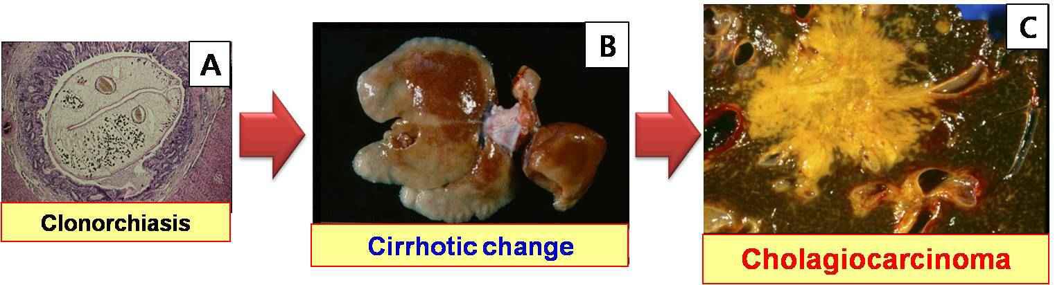 Pathological changes by C. sinensis infection. (A) Hyperplasia in bile duct epithelium and periductal fibrosis. (B) Cirrhotic change of rabbit with chronic infection. (C) Cholangiocarcinoma by Opisthorchis viverrini .