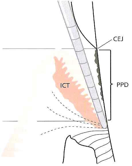 Attachment bone loss