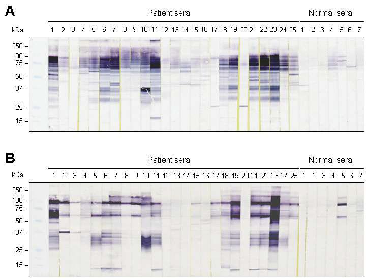 Immunoblot analysis. The soluble fraction (A) and insoluble fraction (B) of G. nipponicum lysate were separated by SDS-PAGE and transferred onto nitrocellulose membrane, respectively. The membranes were cut into strips and each strip was incubated in 1:150 diluted srea from Gnathostoma infected individuals (n=25) or normal healthy persons (n=7). After three times washing with PBST, the strips were probed 1:1000 diluted HRP-conjugated anti-human IgG and developed with 4CN.