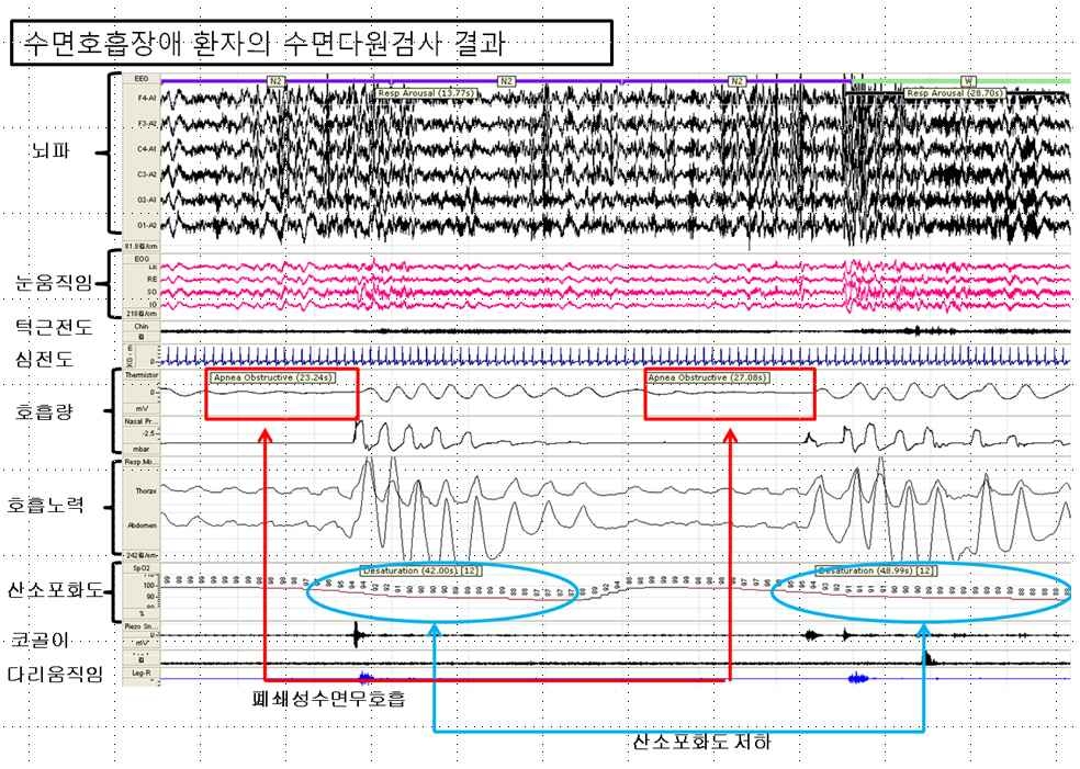 그림 11. 야간수면다원검사의 소견: 호흡이 중간 중간에 중다되고 그 후 혈액의 산소농도가 떨어지는 것을 보여