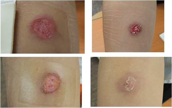 A 고등학생에서 나타난 심한 투베르쿨린 검사 반응들 (severe tuberculin reactions among A high school students)