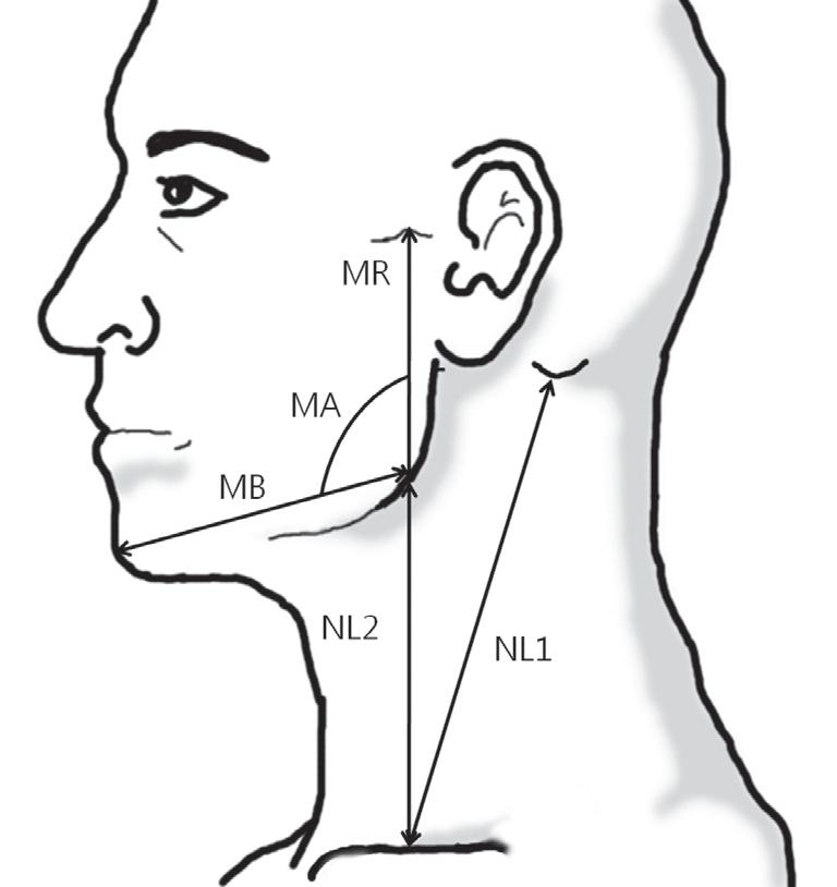 Landmark and reference lines for mandibular and neck measurements. Measurements included mandibular body (MB), mandibular ramus (MR), length of neck (NL) 1, NL 2, and mandibular angle (MA).