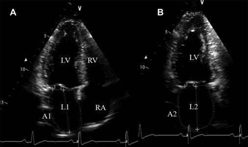 An example of the measurement of the left atrial (LA) volume. A. Apical four-chamber view; B. Apical two-chamber view. LA areas in the apical four- and two-chamber views (A1 and A2, respectively), and LA common long axis (L) can be measured. LA common long axis (L) is the smaller one between L1 and L2. LA volume was calculated using area–length method and modified Simpson’s method.