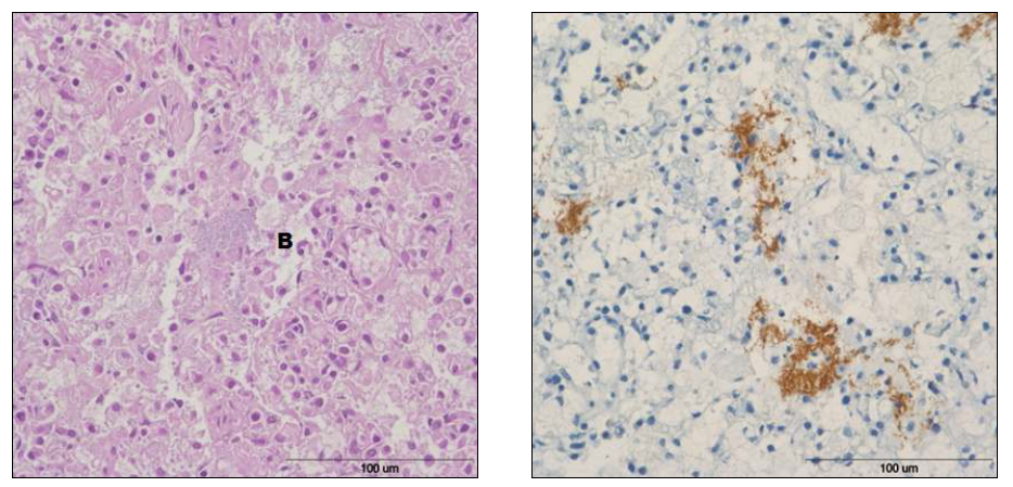 Left panel. Note the A. suis colony (B) and infiltration of macrophages and neutrophils in the alveolar cavity. HE. Bar=100um. Right panel. Detection of the A. suis in the alveolar cavity. ABC. Bar=100um.