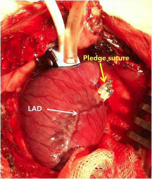 관상동맥 차단을 위한 pledge suture