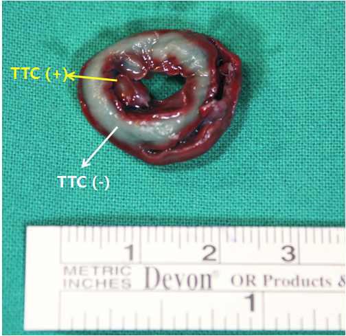 TTC 염색 음성인 infarction 부위