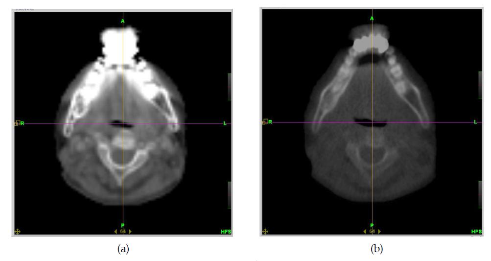(a) kV-CT로 촬영한 금속왜곡이 나타난 환자의 두경부 영상 및 (b)MV-CT로 촬영하여 금속 왜곡이 나타나지 않은 동일 환자의 두경부 영상