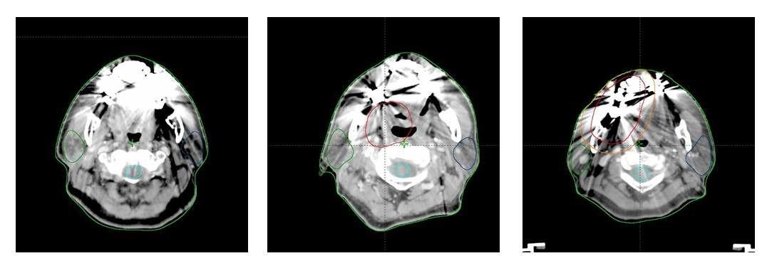 금속 왜곡이 관찰되는 두경부 치료계획용 CT 영상의 예