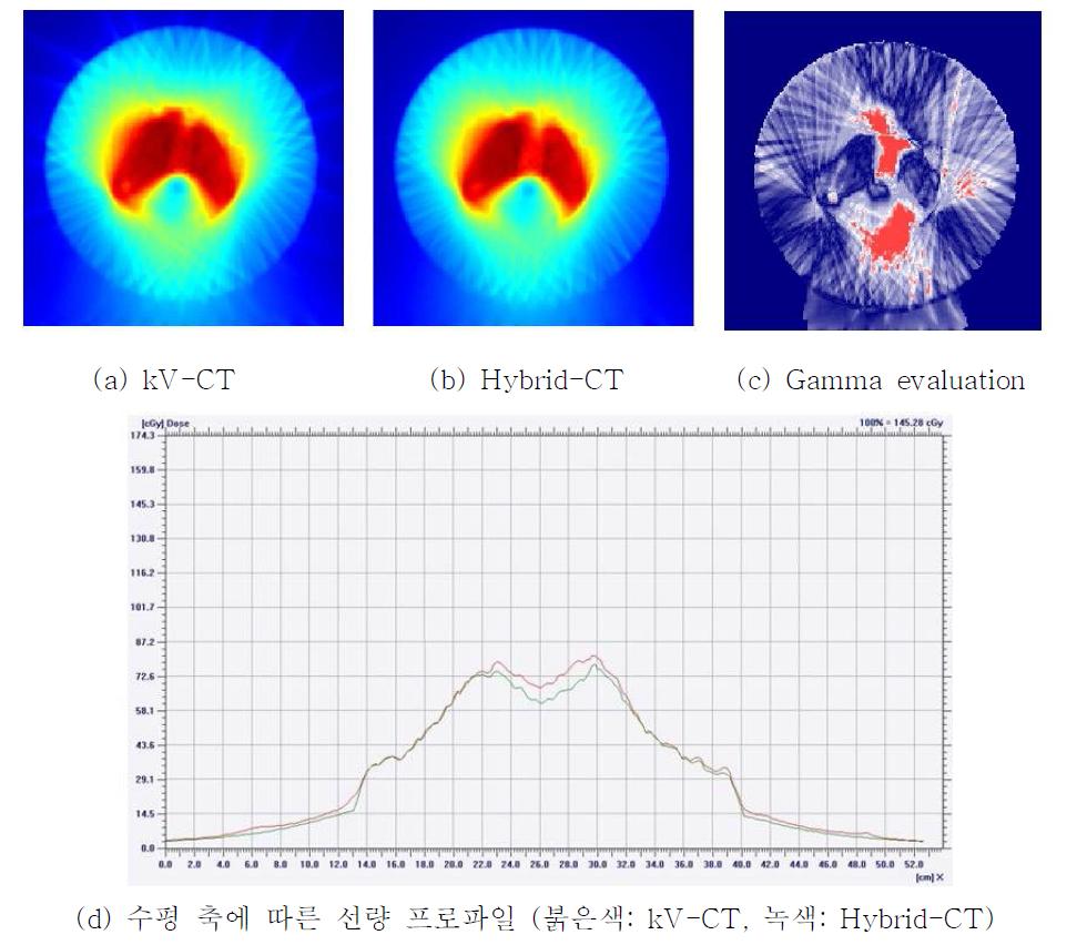 kV-CT 와 Hybrid-CT 영상을 이용한 선량분포 계산 결과 및 감마평가법을 이용한 비교 평가 결과