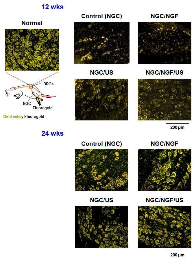 신경유도관, 신경유도관/성장인자, 신경유도관/초음파 및 신경유도관/성장인자/초음파 자극에 의해 재생된 신경의 Fluorogold 역행 추적 결과 (DRGs 부위, x 400).