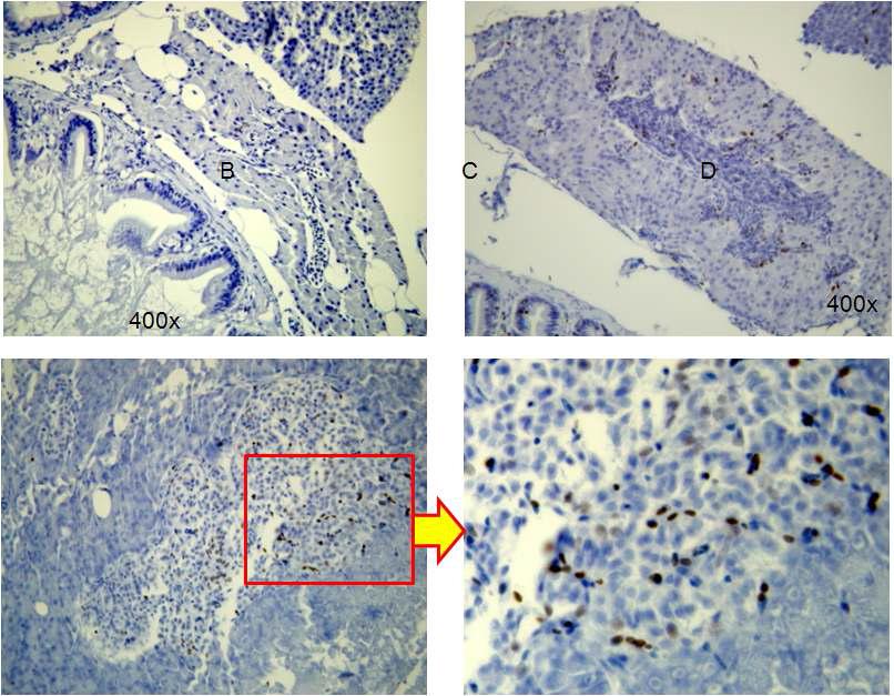 종양에서 mitotic index의 증가.