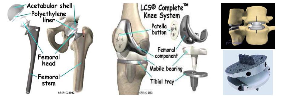 인공고관절, 인공슬관절, 인공디스크의 예.