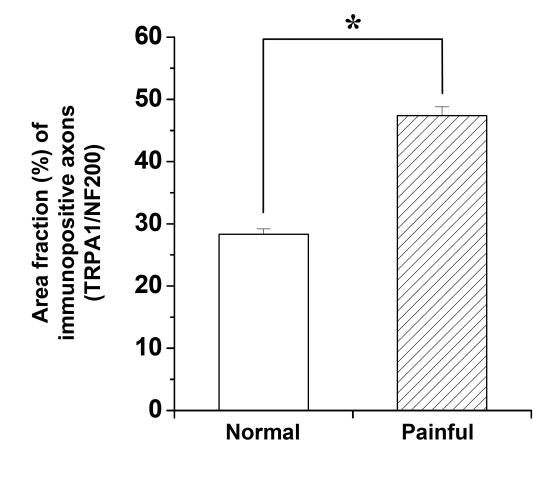 Area fraction (%) of TRPA1+ axons in NF200+ nerve fibers in the normal and painful (irreversible pulpitis) pulp samples. An asterisk indicates a significant difference between normal and painful pulp samples (p < 0.05).