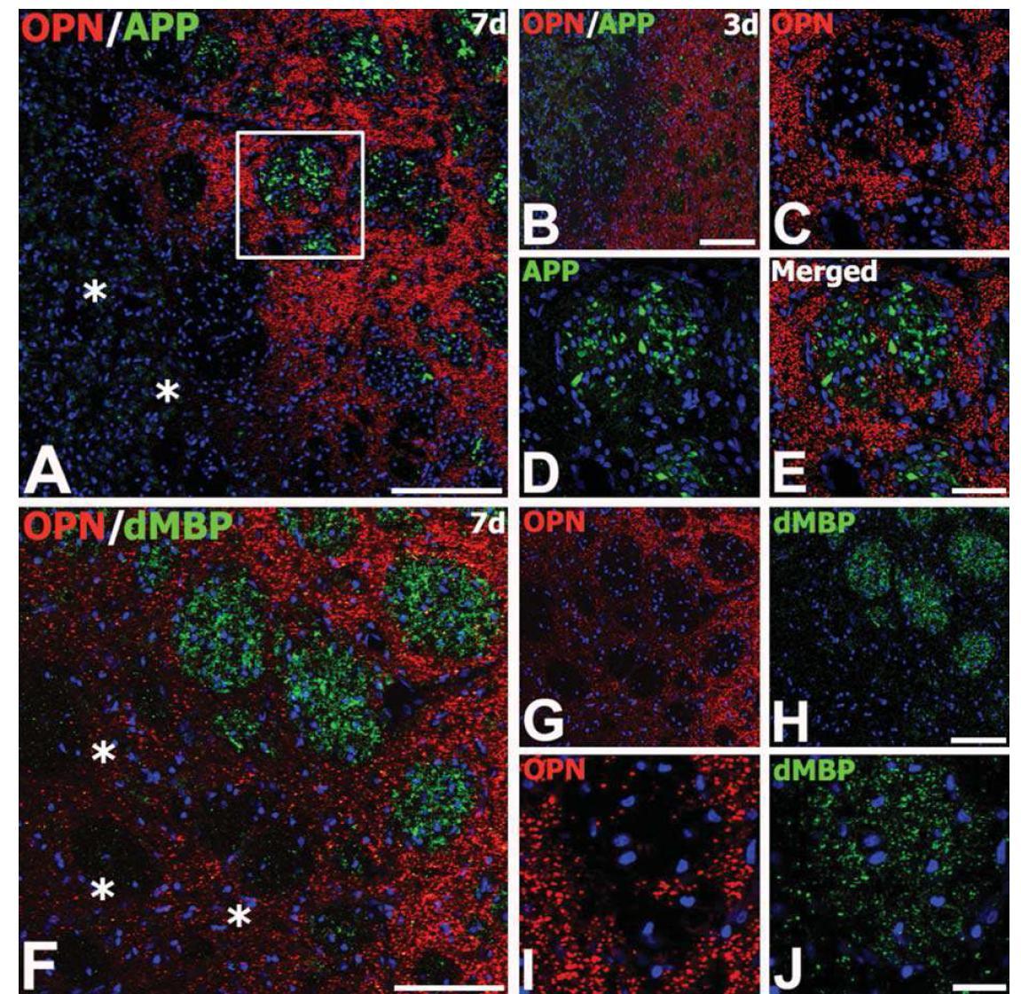 Spatiotemporal relationship of OPN protein along with amyloid precursor protein (APP) or degraded myelin basic protein (dMBP) immunolabeling in the core region at days 3 (B) and 7 (A, C– J) after ische mic injury.