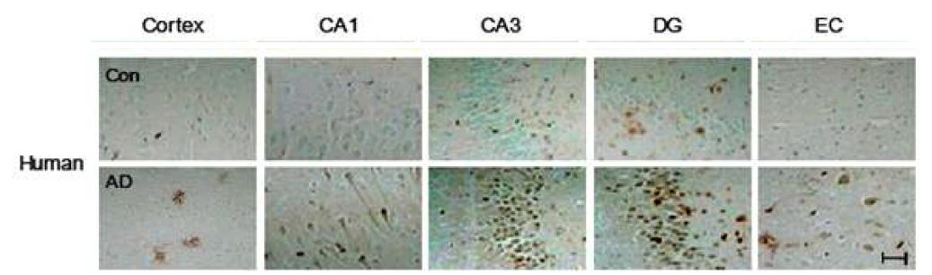 알츠하이머병 환자 뇌의 cortex 부위에서 S100a9의 발현 양상
