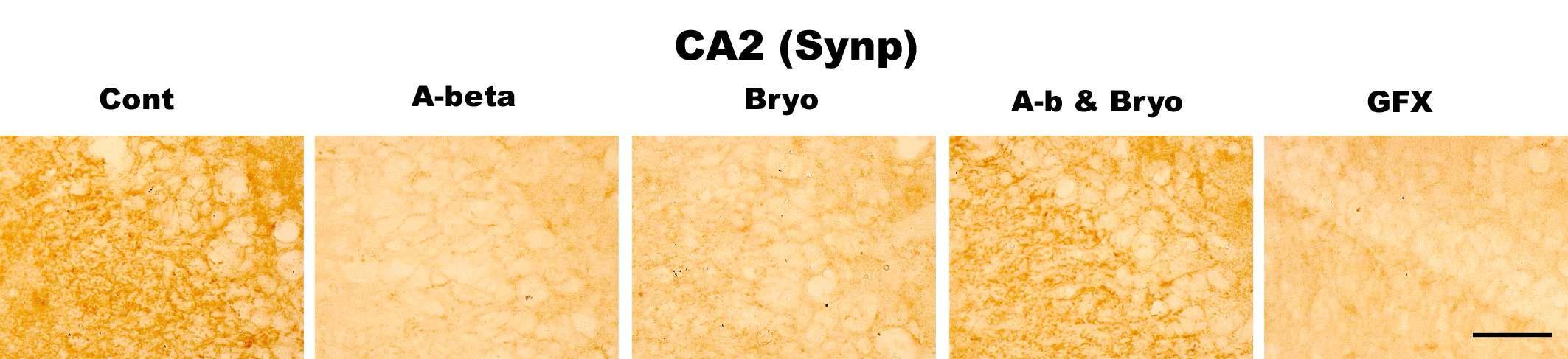 Effects of Bryostatin-1 on synapses in CA2 pyramidal neurons of hippocampus in rat. Bryostatin-1 significantly prevented reduction of synaptophysin (presynaptic protein) in CA2 of rat infused with amyloid beta. PKC inhibitor GFX 109203 reduces synaptophysin in CA2. Intracerebro-ventricular infusion of Aβ and Bryostatin-1 was for four weeks using a micro-osmotic pump. PKC inhibitor GFX 109203 was administrated with I.c.v. injection. Immuno- histochemistry (anti-CD11b) (scale bar, 50μm)(40Χ magnification)