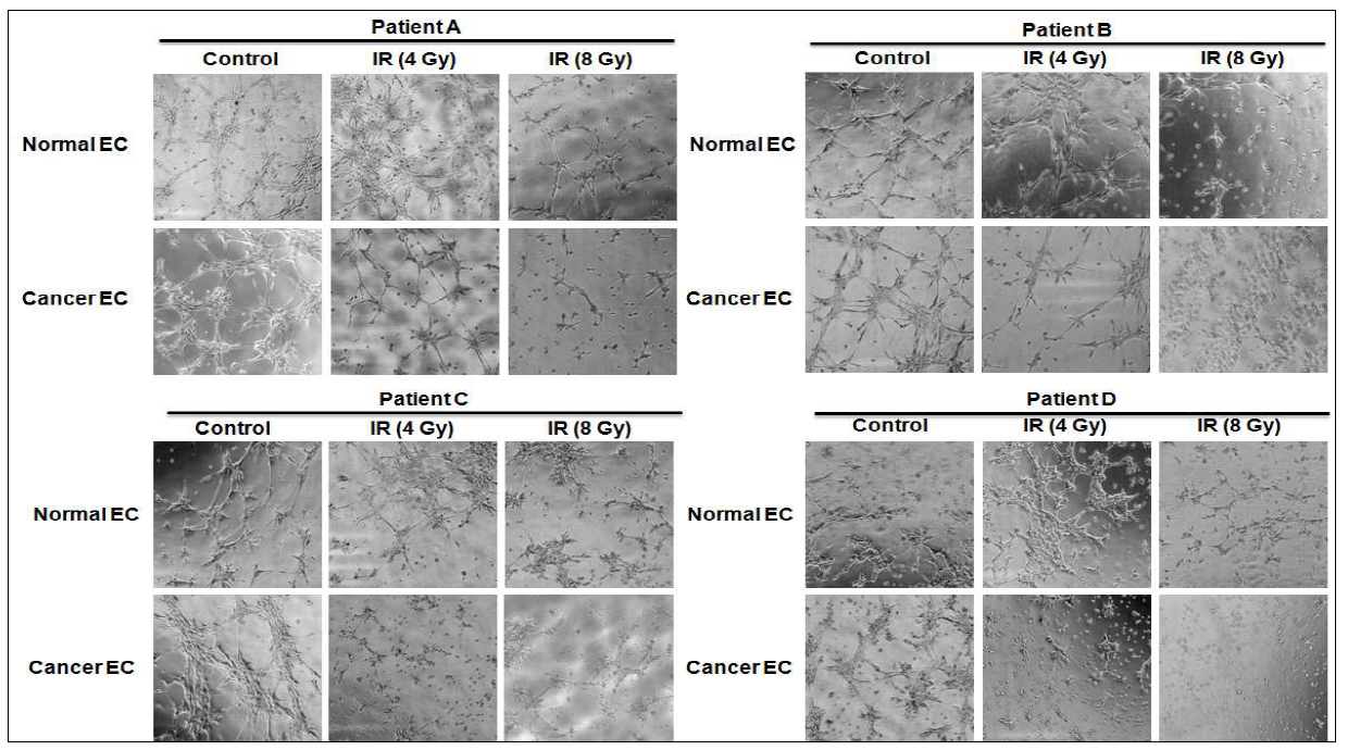 Effect of ionizing radiation on tube formation of normal and cancer endothelial cells.