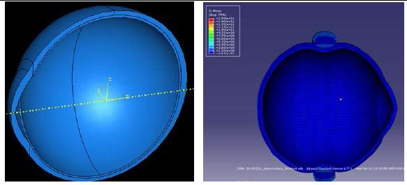 사용된 안구의 형태와 개발된 돌륭술 유한요소 모델