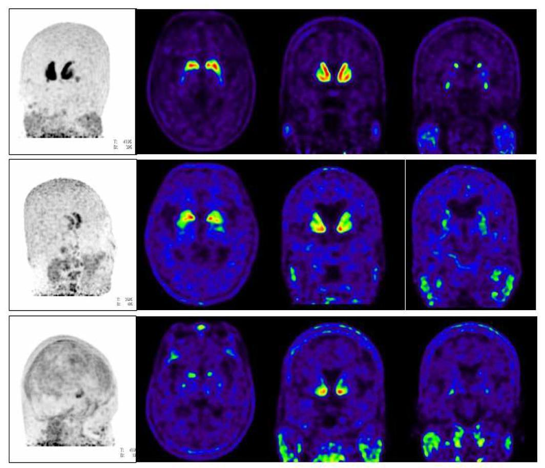 Typical MIP, axial, sagittal and coronal F-18 FP-CIT PET images of PD (up), MSA (middle) and PSP (down) groups