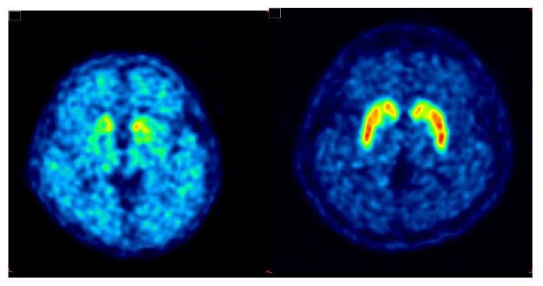 파킨슨병 환자와 정상인의 뇌의 도파민 운반체 영상