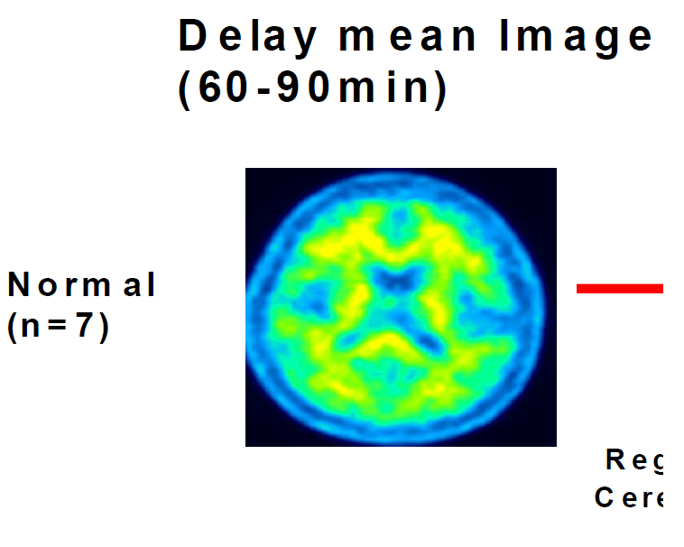ligand 및 disease specific [11C]PIB PET image templates 제작과정