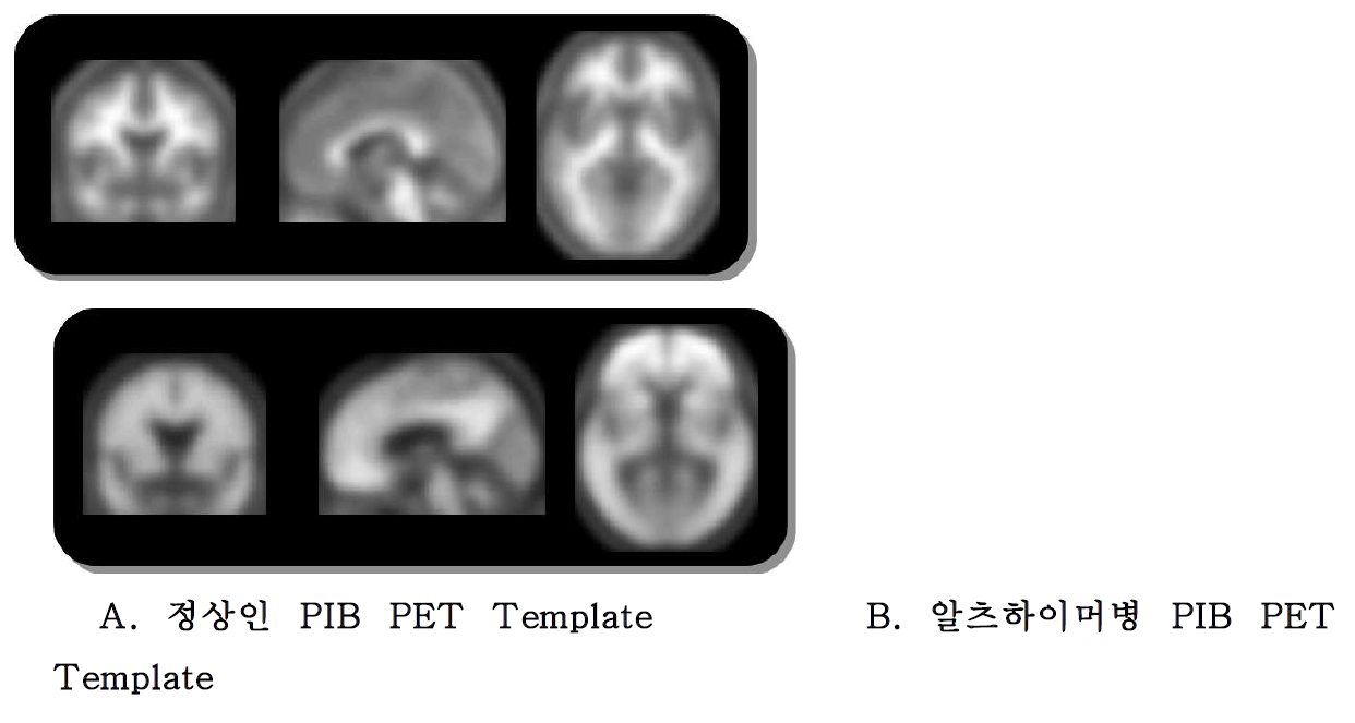 완성된 ligand 및 disease specific [11C]PIB PET image templates