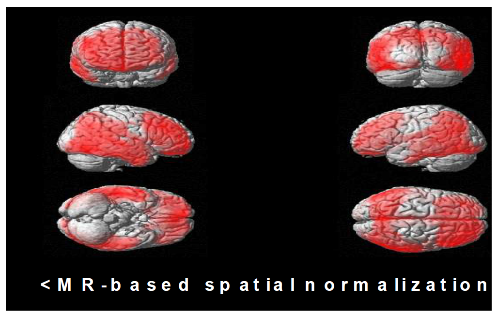 MR 및 PET templates를 이용한 공간정규화 방법으로 얻어진 정상인과 알츠하이머병 환자군의 SPM 비교분석결과 영상들.