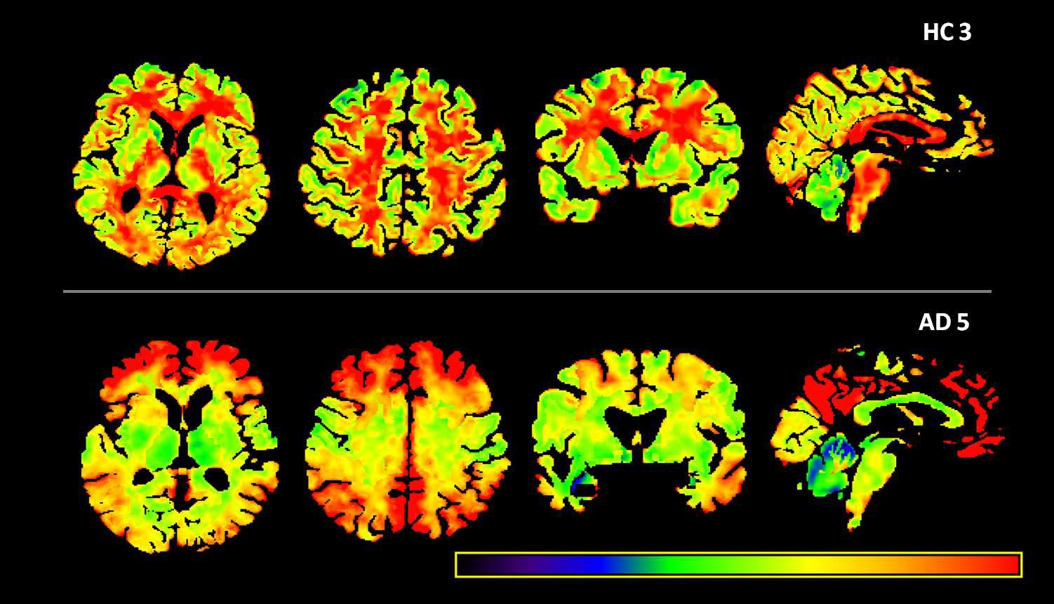 정상인과 알츠하이머병 환자의 뇌위축보정 C-11 PIB PET영상