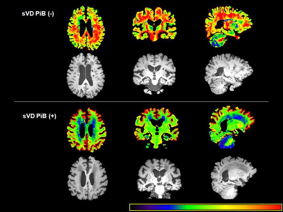 정상과 비정상 PIB PET 소견을 보인 혈관성치매 환자들의 뇌위축 보정 PIB PET 영상