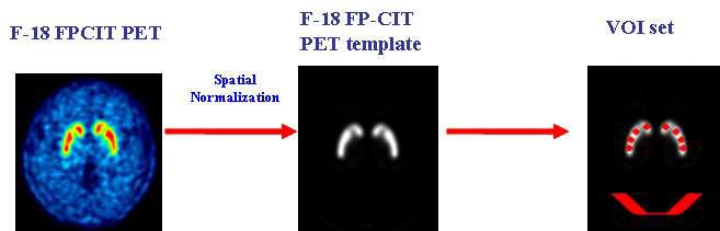 [18F]FP-CIT PET template를 이용한 [18F]FP-CIT PET영상의 공간정규화 및 VOI template