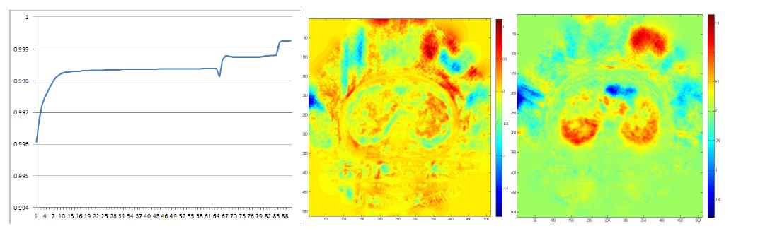 영상 정합 시 iteration 경과에 따른 correlation 값의 변화(그림 좌)와 50% phase 영상과 0% phase 영상에 대하여 기준/변형영상의 역할을 바꾸어 정합/역정합 두 개의 변형벡터필드 DVF를 구하고, 그 성분합에 대한 벡터크기에 대해 영상화한 결과(그림 중, 우). 환자 체적 내 최대 오차는 2 mm 이내임.
