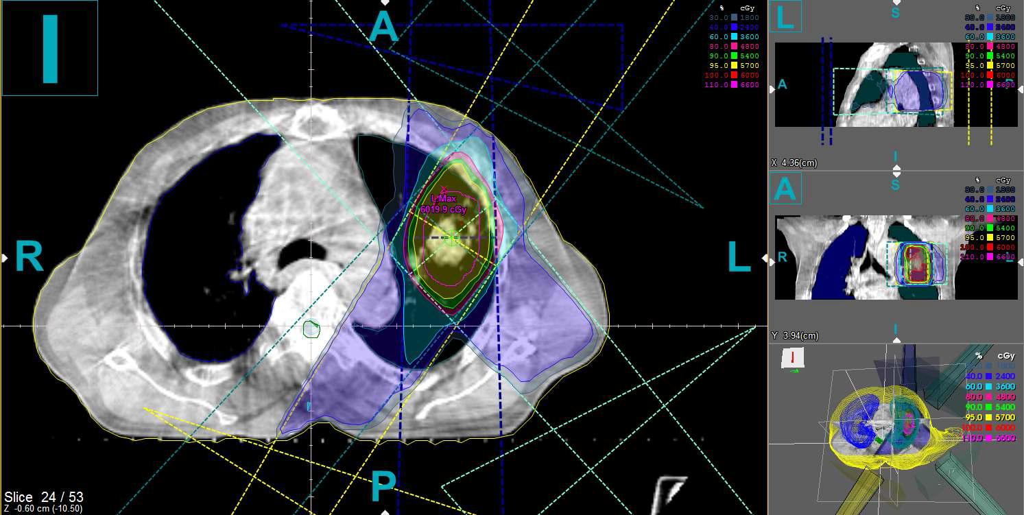 폐암 환자의 Varian Cone Beam CT 영상 기반의 선량 분포 계산 결과: CBCT 영상 값을 적합한 전자 밀도 값으로 변환 후 선량 계산을 수행함, 6MV 광자선을 이용하여 Equivalent TAR 선량 알고리듬으로 계산하였음