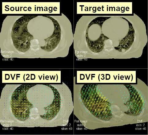 Deformable image registration에 서 displacement vector field (DVF)를 보여 주는 예. 화살표로 표시된 것이 DVF이다