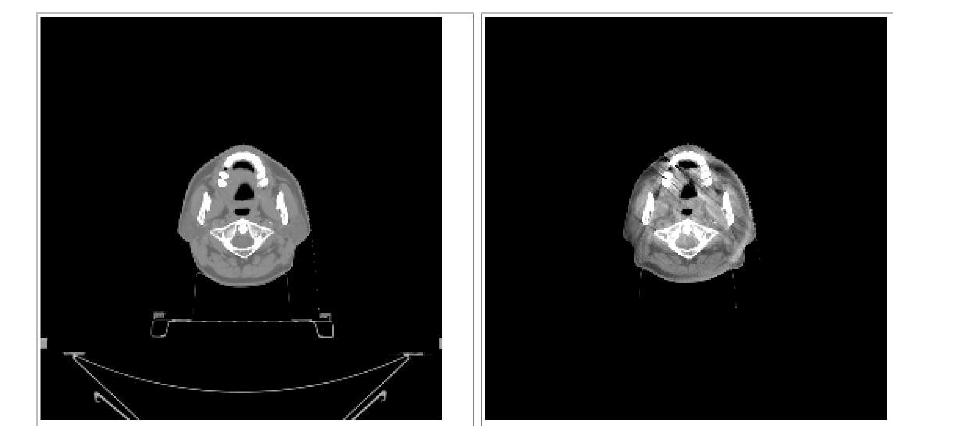 두경부 영역에서의 Metal artifact에 의한 kV Fan beam CT (좌)와 Cone beam CT(우)영상: Cone beam CT에서의 metal artifact는 변형가능영상 정합의 퀄리티를 크게 저하할 수 있음.