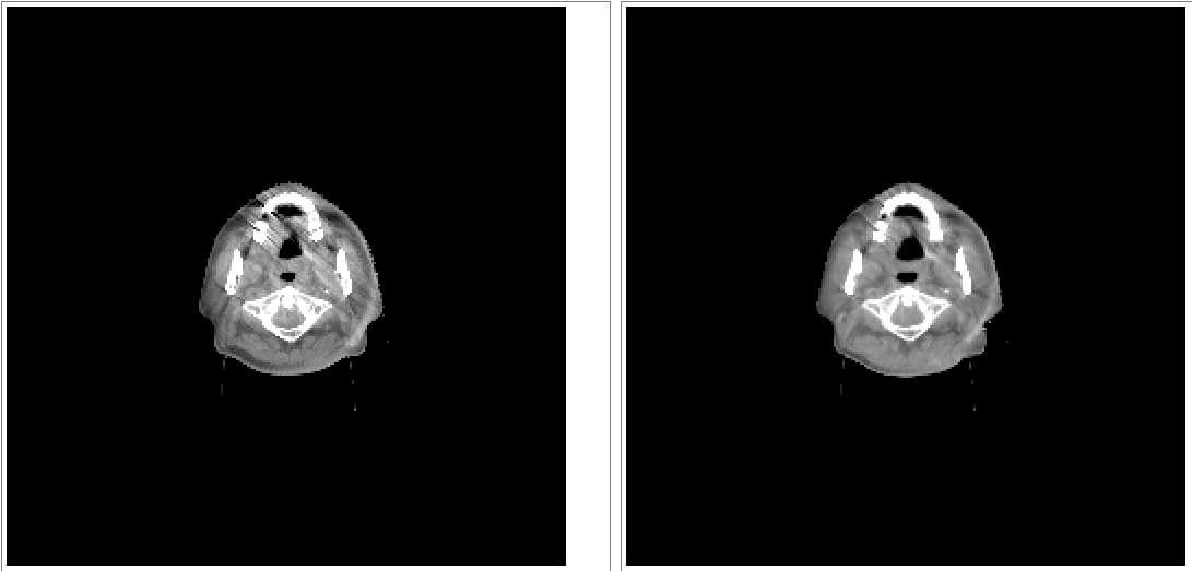 두경부 영역에서의 Metal artifact에 의한 영향을 최소화여 최적화 한 변형가능 영상 결과: 그림 좌는 변형가능 영상정합 전의 Cone beam CT이며, 그림 우는 최적화 방법을 적용하여 변형가능 영상정합을 수행한 결과 영상. Streak artifact가 크게 억제되면서 oral cavity영역의 변형가능 영상정합 및 목 후부 부위의 변형가능 영상정합이 원활하게 이루어짐을 확인 가능함.