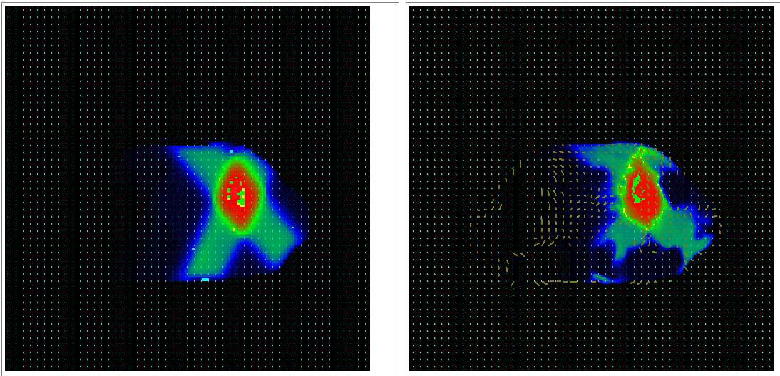 흉부 Lung cancer의 경우의 방사선량 분포와 변형정합 결과에 따른 분포 특성: 그림 (좌)는 변형정합 전 방사선량 분포, 그림 (우)는 3차원 벡터를 이용하여 환자가 해부 학적 구조가 변형될 때 추적된 선량 분포.