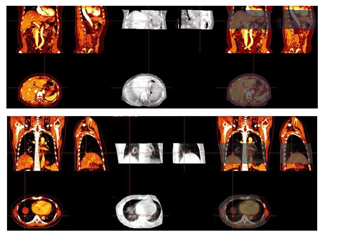 affine transform과 mutual information알고리즘을 이용한 CT-CBCT 영상융합의 예