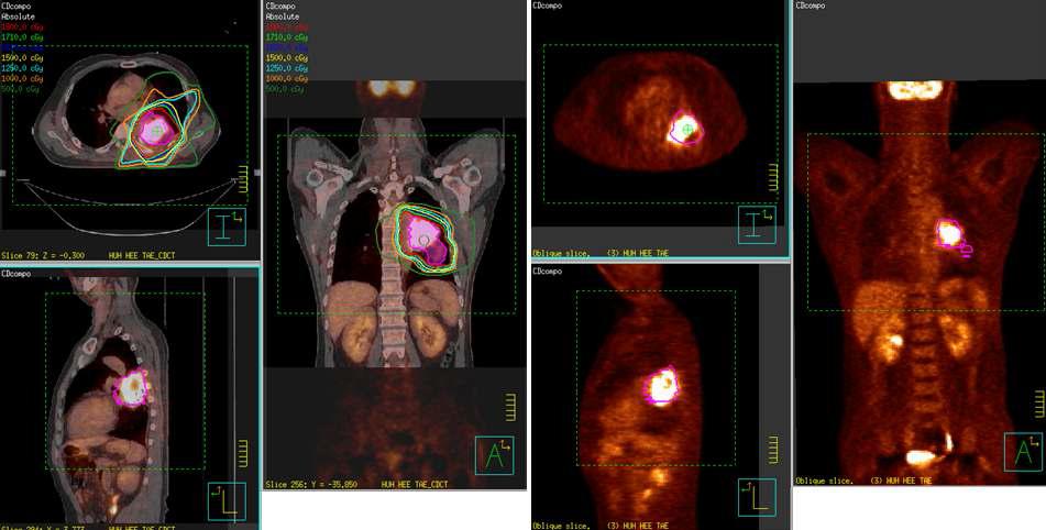 CT-PET 다중영상융합기술기반 종양볼룸최적화