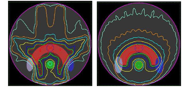 9 field IMRT(좌) 와 single IMRT(우) 에서의 선량 분포 비교