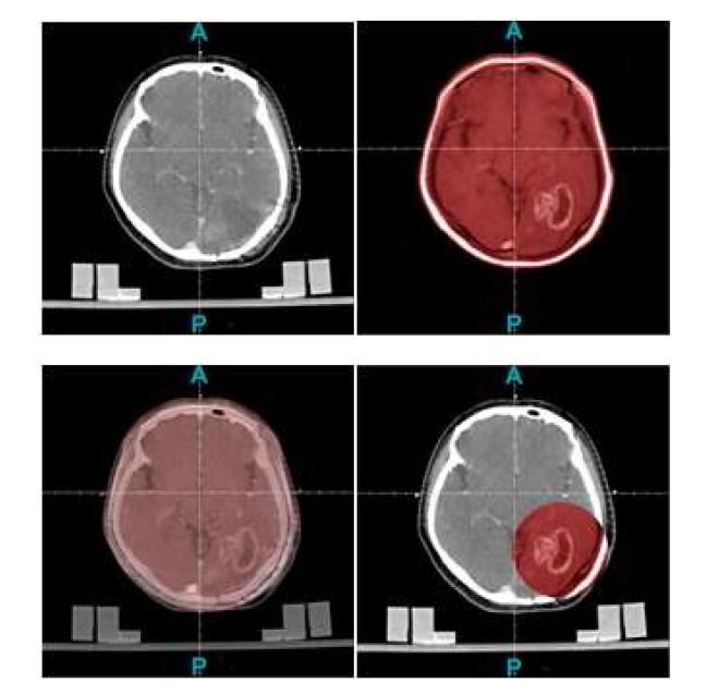 CT/MR 다중 영상 처리 기능 (순서대로 CT, MR, CT&MR, ROI 보기)