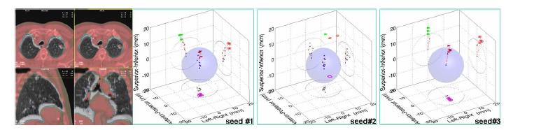 CT/CT registration. Three seed motion showing hysteresis of the tumor motion (mm) due to respiration.