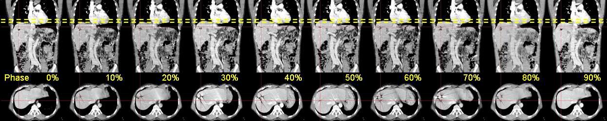 Each phase of a 4D CT image