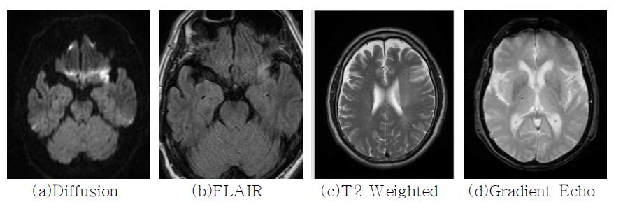 4가지 유형의 뇌 MR 영상
