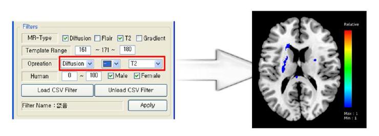 MR Diffusion-T2 유형간의 차집합 연산 결과