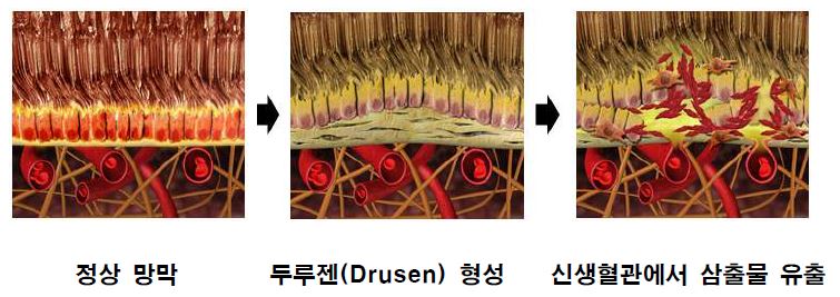 그림 6. 황반변성의 진행과정